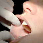 La eritroplasia y la leucoplasia deben investigarse