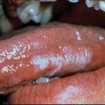 leucoplasia vellosa