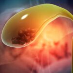 Colecistitis aguda