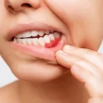 Gingivitis ulcerosa necrotizante
