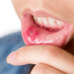 Gingivoestomatitis herpética