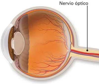 Neuritis óptica