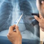 Manifestaciones clínicas de la enfermedad pulmonar obstructiva crónica