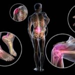 ¿Cuál es el hallazgo patológico característico de la artritis reumatoide?