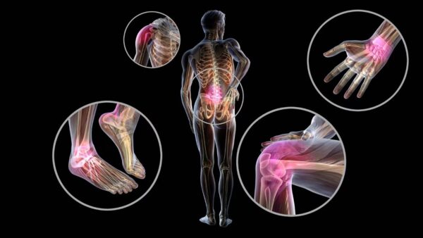 ¿Cuál es el hallazgo patológico característico de la artritis reumatoide?