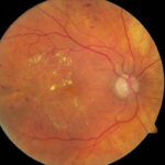 Prevención y factores de riesgo de la retinopatía diabética