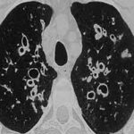 Causas de Bronquiectasia