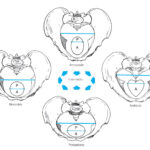 Clasificación anatómica de la pelvis Caldwell-Moloy