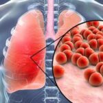Etiología de Neumonía adquirida en la comunidad