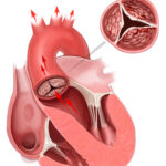 Principales causas de regurgitación aórtica