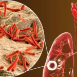 Tratamiento de la tuberculosis latente