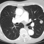 Nódulo pulmonar solitario