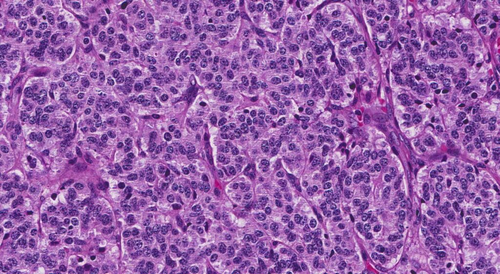 TUMORES CARCINOIDES BRONQUIALES