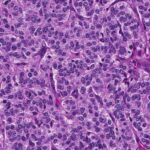 TUMORES CARCINOIDES BRONQUIALES