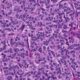 TUMORES CARCINOIDES BRONQUIALES