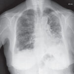 Enfermedad Pulmonar Intersticial