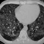 NEUMONÍAS INTERSTICIALES DIFUSAS