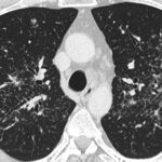 Sarcoidosis pulmonar