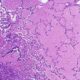Proteinosis alveolar pulmonar