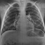Síndromes pulmonares eosinofílicos