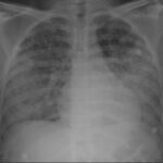 Síndromes de hemorragia alveolar
