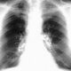 ¿Qué son las neumoconiosis?