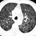 Neumonitis por hipersensibilidad
