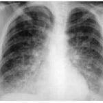 nfermedad pulmonar inducida por medicamentos