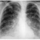 nfermedad pulmonar inducida por medicamentos
