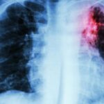 Daño pulmonar por radiación