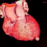 Aneurisma del Ventrículo Izquierdo en pacientes con infarto