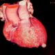 Aneurisma del Ventrículo Izquierdo en pacientes con infarto