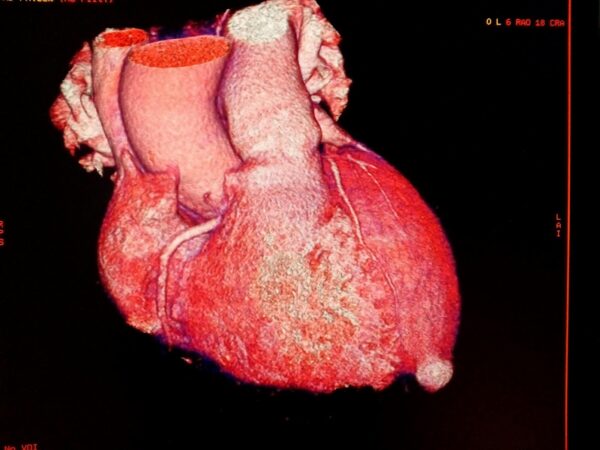 Aneurisma del Ventrículo Izquierdo en pacientes con infarto