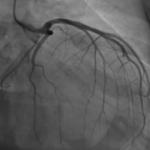 Angiografía coronaria en pacientes con infarto agudo de miocardio con elevación del segmento ST.