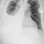 Derrame pleural
