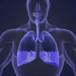 Manifestaciones de los derrames pleurales