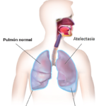 Tratamiento de los derrames pleurales