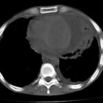 Derrame y taponamiento pericárdico