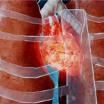 Enfermedad por trauma cardíaco