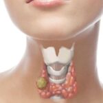 Tratamiento de Nódulos Tiroideos Solitarios Tóxicos