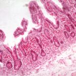 Enfermedad de Whipple