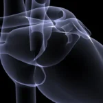 Pericarditis en pacientes con infarto