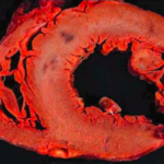 Ruptura Miocárdica en pacientes con infarto al miocardio