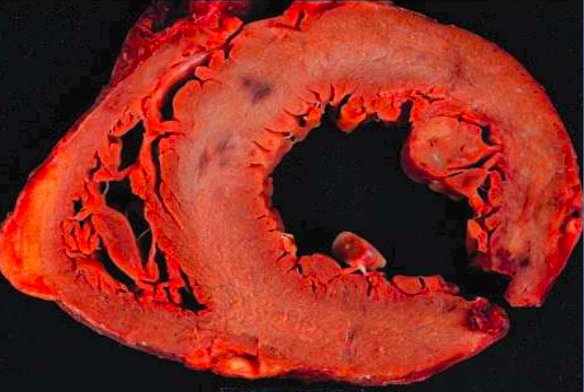Ruptura Miocárdica en pacientes con infarto al miocardio
