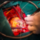Tratamiento de la regurgitación mitral primaria