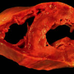 Miocarditis no infecciosa