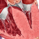 Definición de mocardiopatía hipertrófica