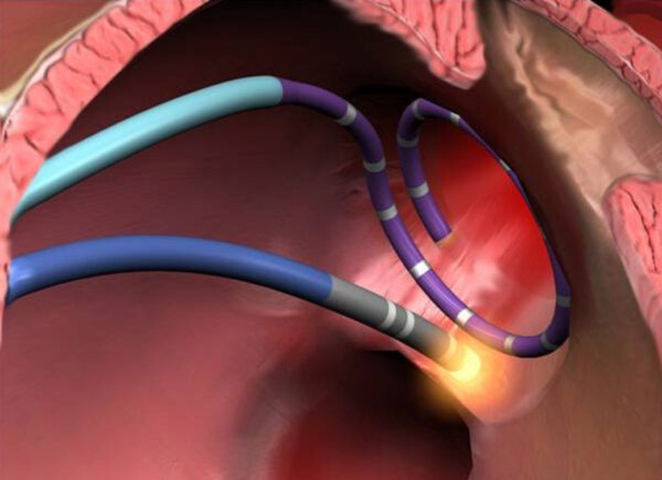 Ablación con catéter para arritmias cardíacas