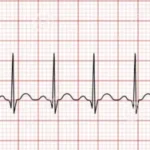 Arritmia sinusal, bradicardia y taquicardia.