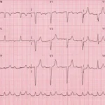 Bloqueo auriculoventricular (AV)